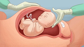 What is c-section?